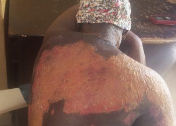 Pregnant woman in labour scaled with hot water in Adamawa