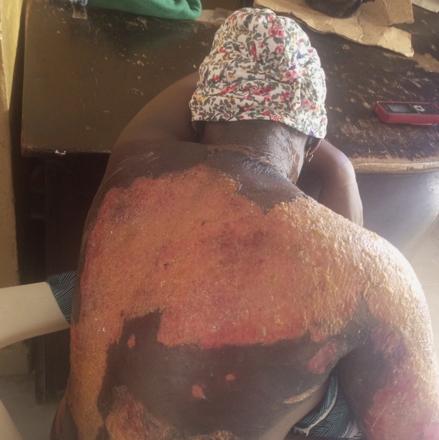 Pregnant woman in labour scaled with hot water in Adamawa