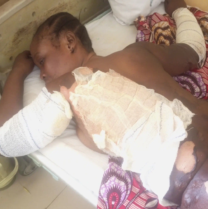 Jealous Ex-Wife Attacks Fiancee of Former Husband with Hot Water in Adamawa